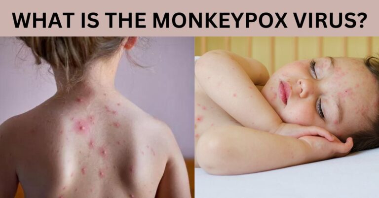 What is the Monkeypox virus? Is there an outbreak of the monkeypox virus in India?