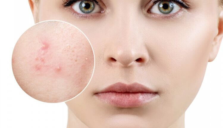 mat-na-mat-ong-nghe-tri-mun-trung-ca