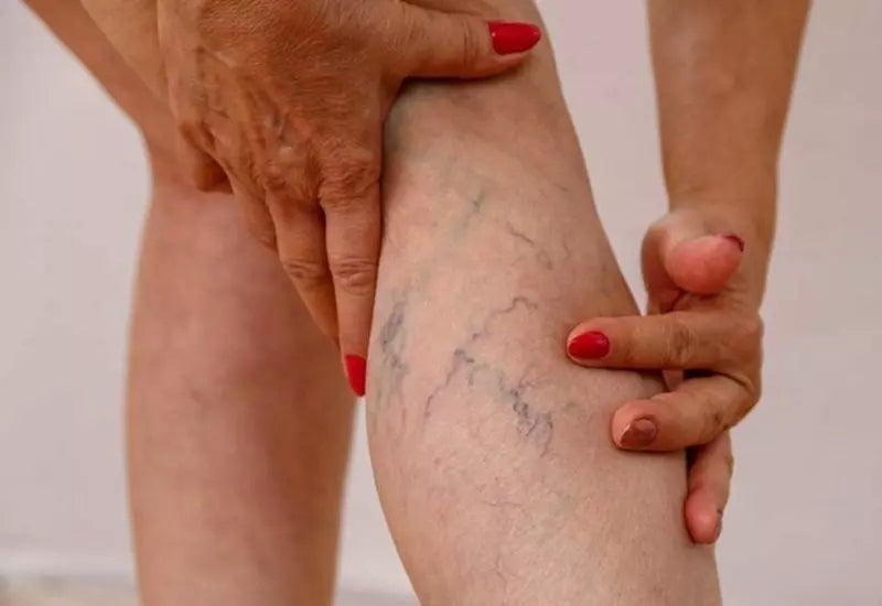 giảm tình trạng giãn tĩnh mạch